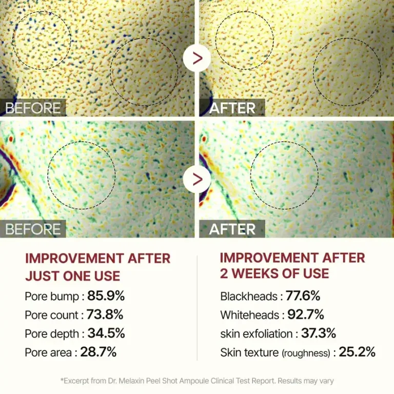 Why PHA is the gentler alternative to AHA